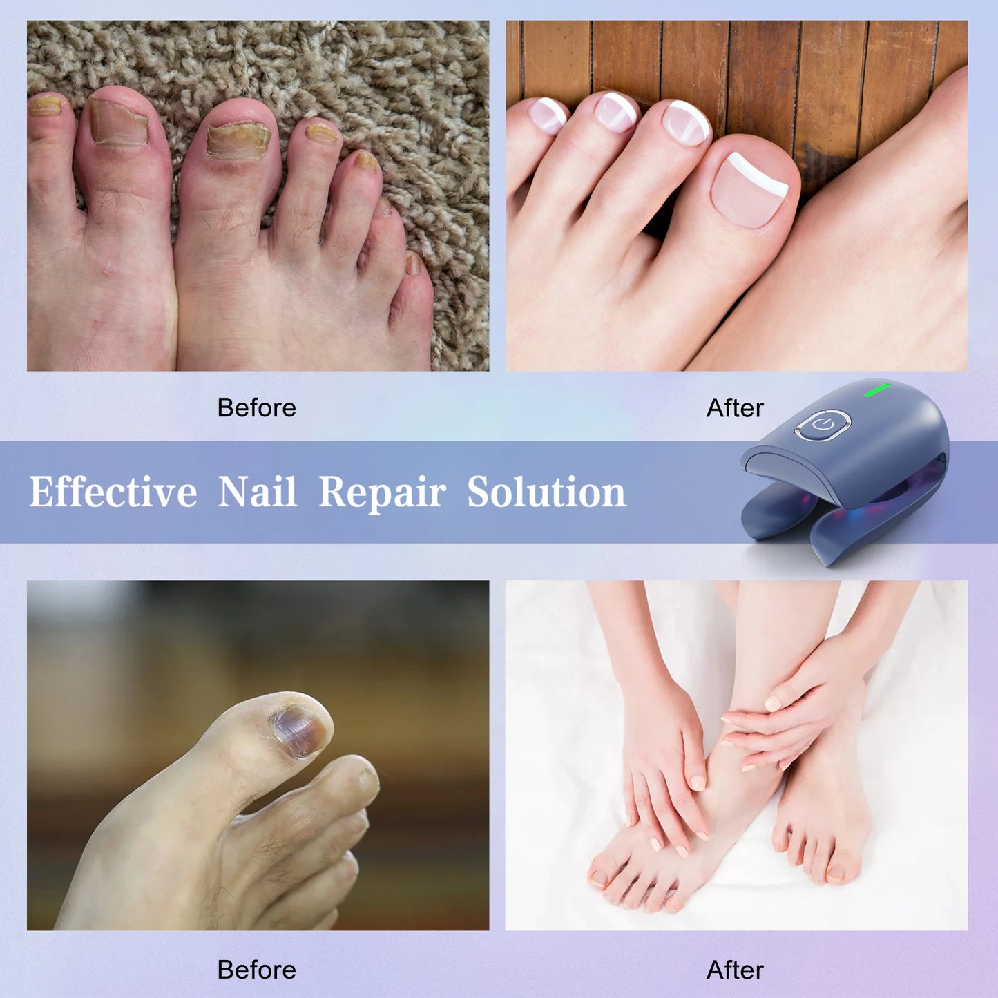 Nail Fungus Cleaning Device, Nail Fungus Cleaning Machine, Portable Nail Thickening And Decolorization Fungus Remover