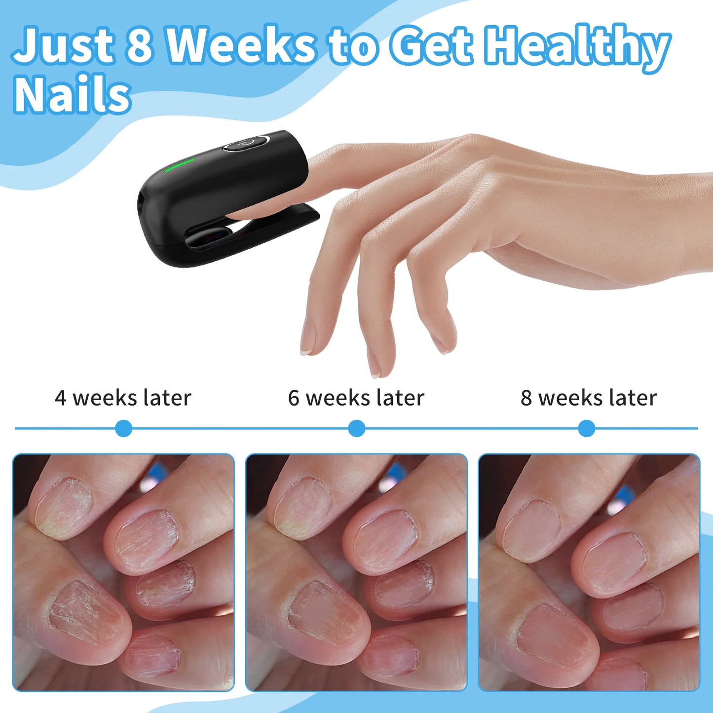 Nail Fungus Cleaning Device, Nail Fungus Cleaning Machine, Portable Nail Thickening And Decolorization Fungus Remover